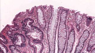 Colon tubular adenoma demonstrating low grade dysplasia  Microscopic diagnosis [upl. by Aivital895]