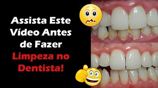 Limpeza nos Dentes Qual o Valor e Como é Feita  Dentista Responde Dúvidas Sobre Remoção de Tártaro [upl. by Bainbrudge263]