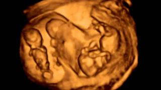 3D ultrasound Dichorionic triamniotic triplets 12 weeks [upl. by Beetner457]