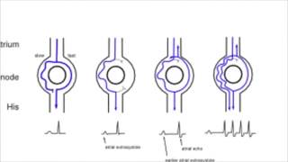 AVNRT AV nodal reentrant tachycardia [upl. by Nylauqcaj]