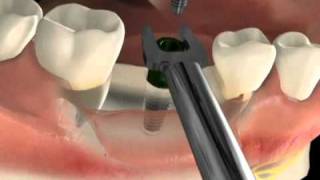 Cirurgia de implante dentário  Vídeo da técnica  São Paulo SP [upl. by Plusch]