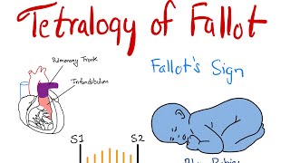 Tetralogy of Fallot Pathogenesis Signs and Management Everything you need to know [upl. by Mur]