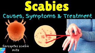 Scabies Causes Symptoms Diagnosis Treatment amp Prevention [upl. by Paik789]