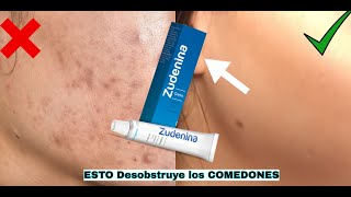 ADAPALENO El Remedio para COMEDONES CERRADOS papulas y pustulas✅ RESULTADOS REALES EN SEMANAS [upl. by Upali526]