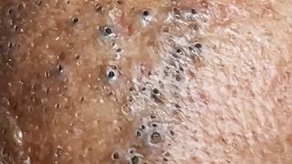 Blackheads amp Whiteheads Satisfying Removal 0050 [upl. by Yremrej]