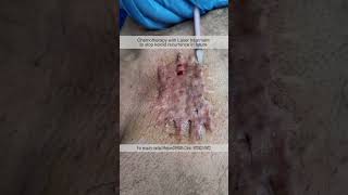 Keloid Maintenance Session Chemotherapy with Laser treatment to stop keloid recurrence in future [upl. by Esojnauj630]