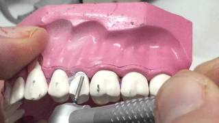 PFM second premolar preparation 1 [upl. by Mohamed]