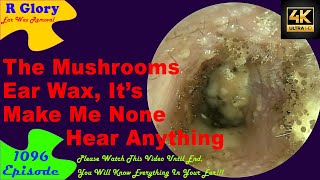 The Mushrooms Ear Wax Its Make Me None Hear Anything🤷‍♂️New Video 1096 ear health newvideo [upl. by Berstine]