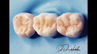 Occlusal Stamp techniques [upl. by Alanson]