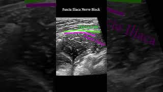 Fascia Iliaca Plane Block ultrasound nerveblock anatomy [upl. by Inattyrb]