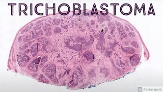 Trichoblastoma amp Trichoepithelioma Benign Hair Follicle Tumor Mimic of Basal Cell Carcinoma [upl. by Viole]