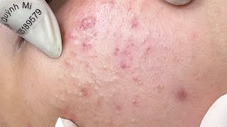 ACNE TREATMENT VU QUYNH MI Acne On Boys Chin 2024 [upl. by Nitsew]