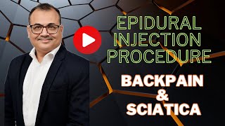 Epidural injection for low back painSciatica pain [upl. by Gwenora330]