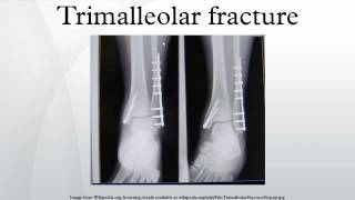 Trimalleolar fracture [upl. by Lazes]