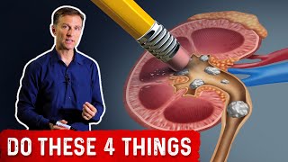 Preventing High Oxalate Kidney Stones [upl. by Nattie155]