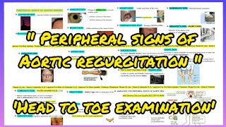 All PERIPHERAL SIGNS OF AORTIC REGURGITATION  DE MUSSETS SIGN  DUROZIEZ SIGN  WATER HAMMER PULSE [upl. by Collins]