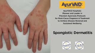 Significant Recovery from Spongiotic Dermatitis Eczema AyurVAID Hospital Domlur Bangalore [upl. by Jerol]