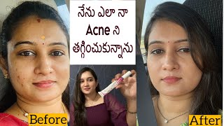 How I Cleared My Acne and Marks  My Acne Journey Clear Skin With Pictures  Treatment amp Products [upl. by Dami]