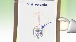 03 Vias de administração da dieta enteral ou por sonda [upl. by Souvaine]