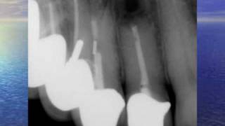 Fistula Could Trick You  Three Endodontic Cases [upl. by Nodnas452]