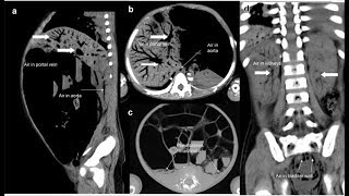 Pneumatosis intestinalis und tödliche portosystemische Luftembolie [upl. by Cassell378]