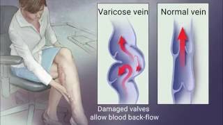 How to Treat a Swollen Vein [upl. by Mcleroy690]