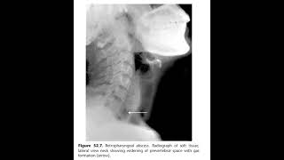 Acute retropharyngeal abscess [upl. by Ahsiya]