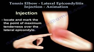 Tennis Elbow Lateral Epicondylitis Injection Everything You Need To Know [upl. by Anelrihs]