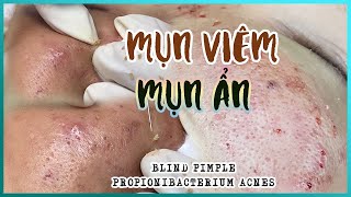 Big Cystic Acne Blackheads Extraction Blackheads amp Milia Whiteheads Removal Pimple Popping [upl. by Lumpkin]