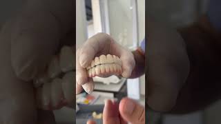 Kronen Veeners amp Implantate in der Türkei Antalya 🦷✅Unkompliziert anfragen 📩veneers zähne [upl. by Dianuj]