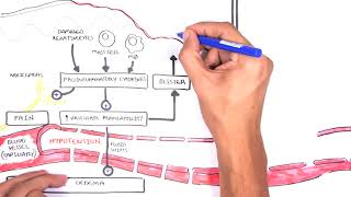 Burns  Pathophysiology [upl. by Ynej]