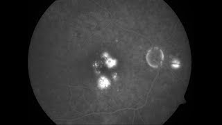 Fluorescein Angiography Phases [upl. by Haile]