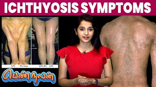 Ichthyosis நோய்யின் Symptoms இது தான்  Remedies For Ichthyosis  Pen Nalan  IBC Mangai [upl. by Aitsirt]