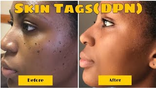 BEFORE AND AFTER DERMATOSIS PAPULOSA NIGRA REMOVAL RESULTS IN 1 WEEK  VIDEO  PHOTOS INCL [upl. by Gibbon509]