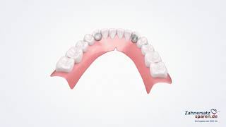 Behandlungsablauf Coverdenture  Zahnersatzsparende [upl. by Aitas]