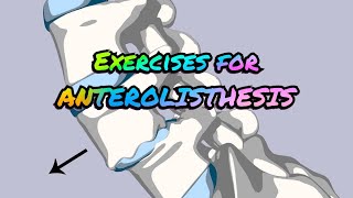 Exercises for ANTEROLISTHESIS [upl. by Hermie640]