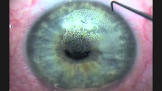 Bladeless All Laser Lasik quot In Simple Englishquot [upl. by Thamos445]