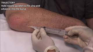 Olecranon Bursitis  Aspiration and Injection  In Vivo Series [upl. by Otsuj]