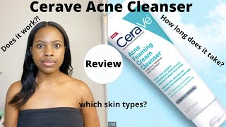 I Tried PanOxyl Acne Forming Wash 10 Benzoyl Peroxide For Two Weeks  review  before amp after [upl. by Nivag166]