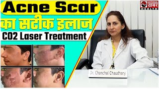 Acne Scar Treatment Fractional CO2 Laser  La fameux Derma। National Health [upl. by Franci]