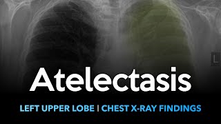 Atelectasis Left Upper Lobe Explanation of Chest Xray Findings [upl. by Ahsehyt256]