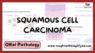 Histopathological grading of Squamous Cell Carcinoma SIMPLIFIED  Oral Pathology [upl. by Fitting]