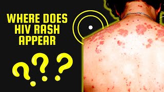 Where does HIV Rash Appear   Skin Conditions Associated with HIV [upl. by Sleinad]