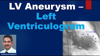 LV Aneurysm – Left Ventriculogram [upl. by Odiug]