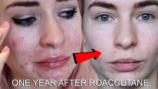 ONE YEAR AFTER ROACCUTANE  MY SKIN NOW [upl. by Marmion]