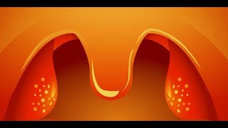 Normal tonsils vs swolleninflammed tonsils PicturesImages [upl. by Ahsihat]