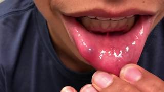 Popping a Lip Cyst Mucocele Causes Symptoms and Treatment Extended [upl. by Aketahs]