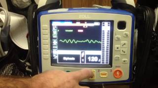 Defibrillation on Zoll X series [upl. by Pence]