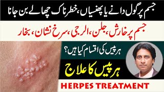 What is Herpes  Herpes ka ilaj  Herpes trearment in urdu  Dano ka ilaj  Dr Jahangir Yasir [upl. by Kylie4]