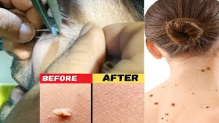 warts removal treatment and heading processموہکوں کا جڑھ سے خاتمہ [upl. by Naesyar]